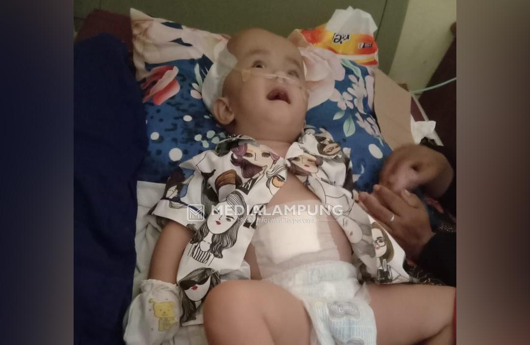 Naila, Bayi Penderita Hydrocephalus Ini Butuh Uluran Tangan Dermawan