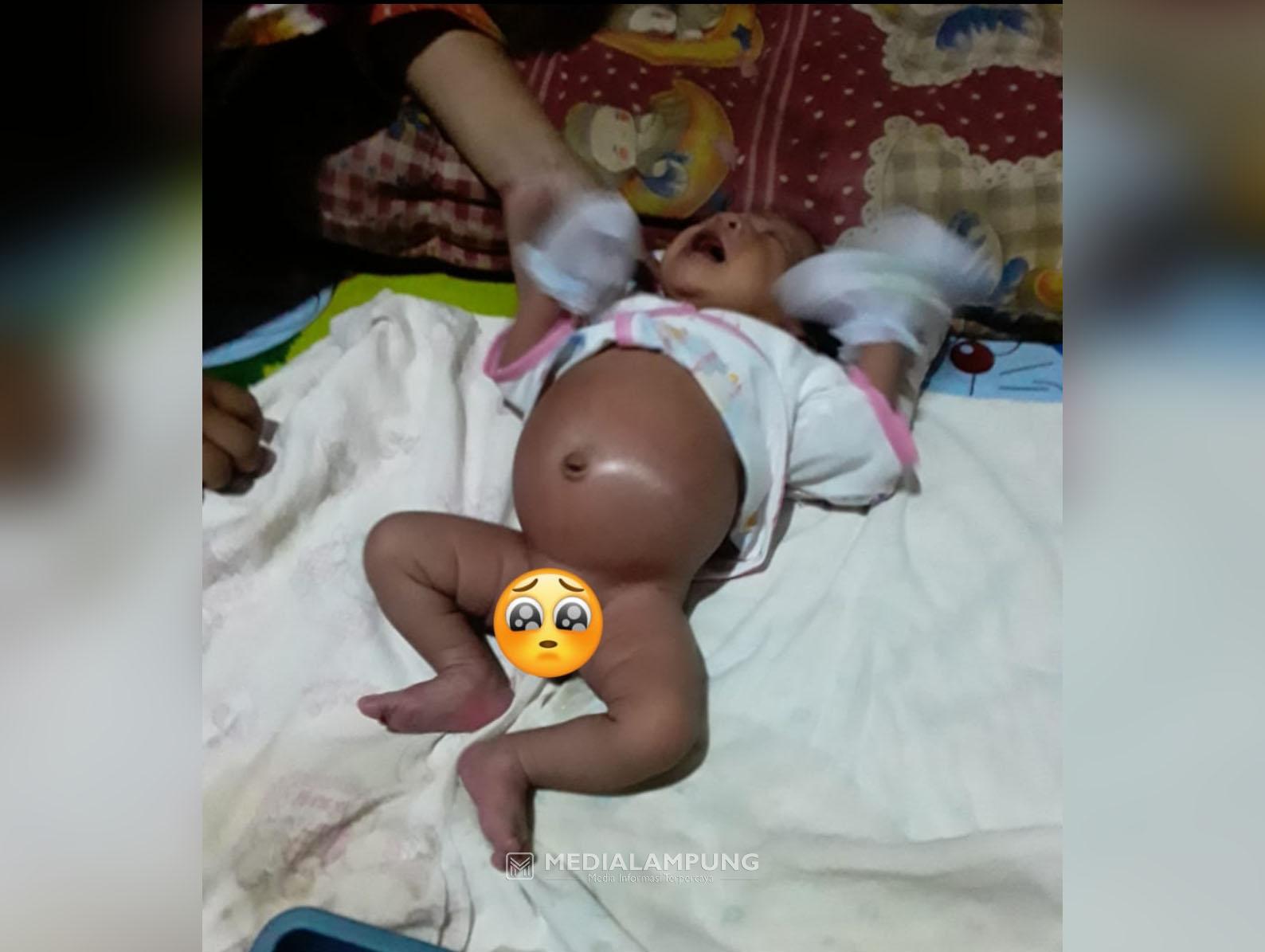 Bayi Penderita Penyempitan Usus di Pekon Sukajaya Harapkan Uluran Tangan Dermawan